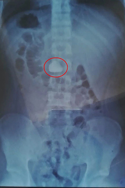 红圈内为X光透视下胃内的石头