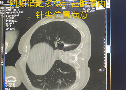 射频消融多极针在肿瘤内