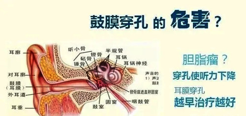 鼓膜穿孔的危害