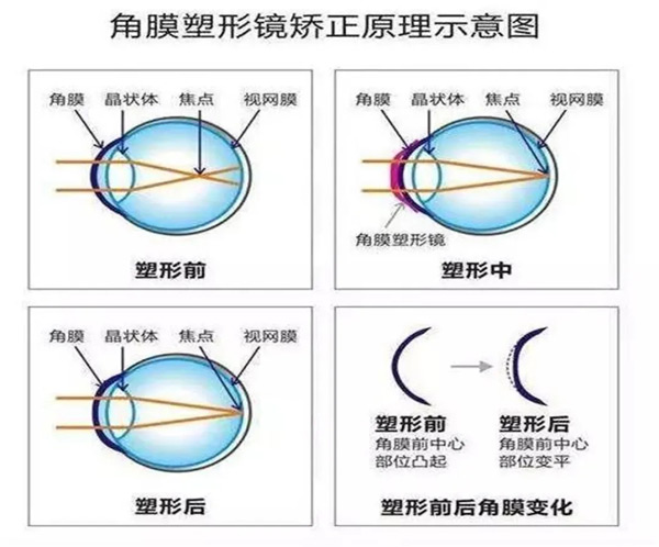 “C位出道”的角膜塑形镜到底是什么？