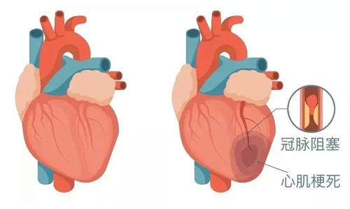 5种信号提示心肌梗死发作 10个时段需要格外警惕