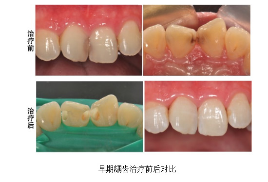 蛀牙真的是牙被虫蛀了吗？