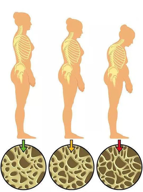 骨质疏松九大常见误区你了解吗？
