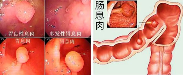 胃肠里长个“小疙瘩”切还是不切？