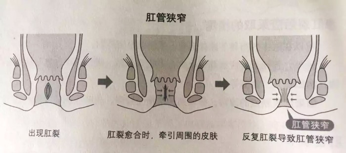 什么是肛裂？什么原因会引起肛裂？