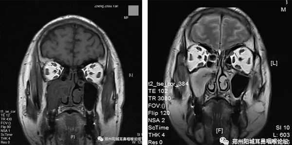 患者严重头痛需手术，心脏严重病变风险高，该何去何从？