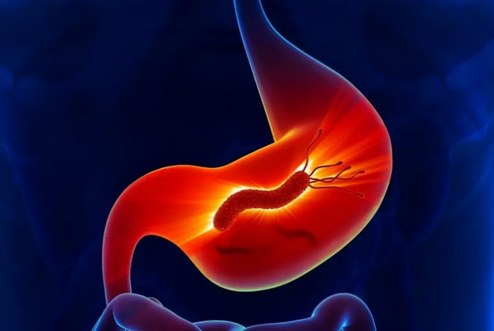 70%以上胃癌与幽门螺杆菌有关？如何检测治疗和预防？
