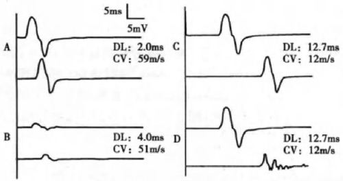 图 6. A. 正常；B. 轴索变性（波幅明显降低）；C. 髓鞘脱失（两条线潜伏期差明显 ↑，传导速度 ↓）；D. 髓鞘脱失伴传导阻滞和波形离散