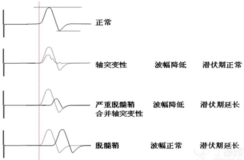 脱髓鞘与轴索损害鉴别