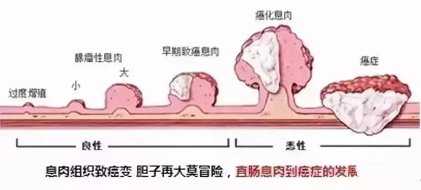 息肉癌变过程
