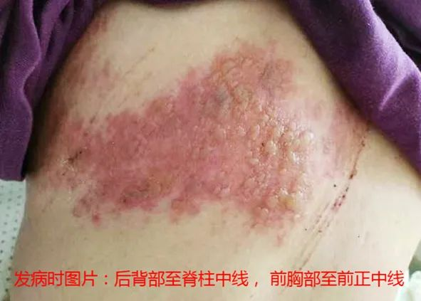 “蛇缠腰”痛起来像被100个容嬷嬷拿针扎？