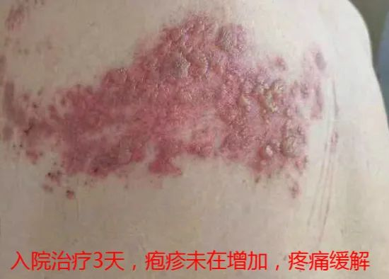 “蛇缠腰”痛起来像被100个容嬷嬷拿针扎？