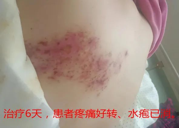 “蛇缠腰”痛起来像被100个容嬷嬷拿针扎？