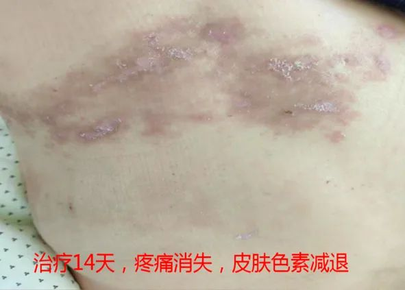 “蛇缠腰”痛起来像被100个容嬷嬷拿针扎？