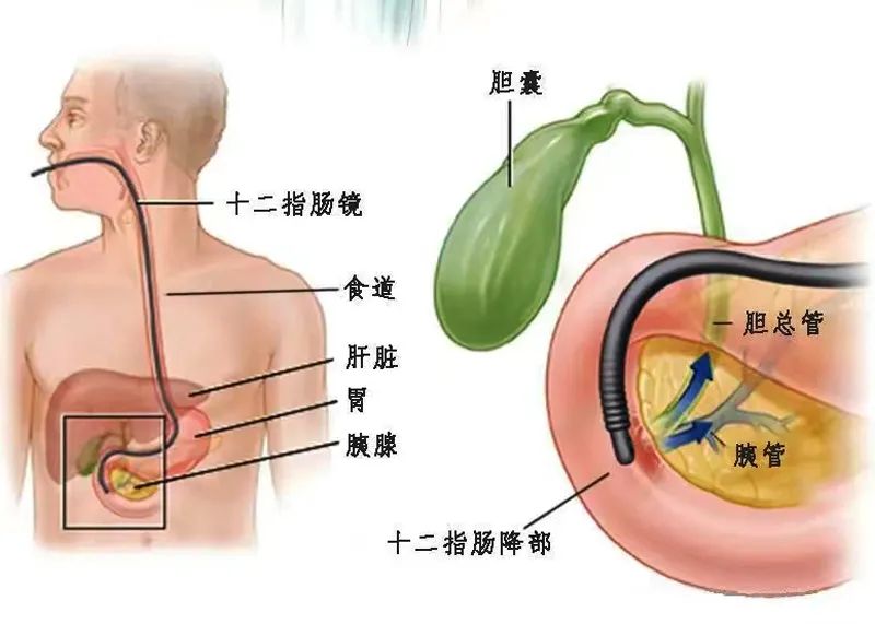 身体里隐藏着“疯狂的石头”，如何拯救？