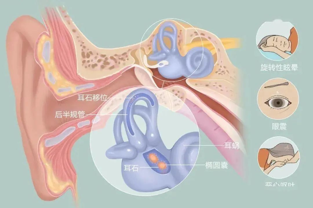 动不动就天旋地转 ，这样的感觉，你也有吗？