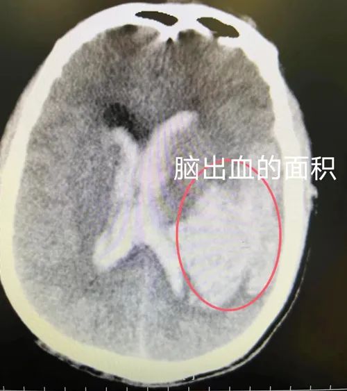 56岁的他，为何时隔10年再发脑出血？