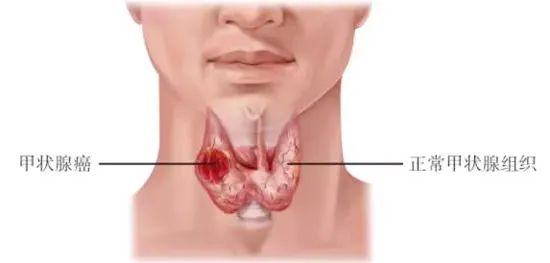 甲状腺癌冲上“热搜”！是良是恶？一针见分晓！