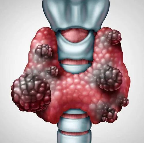 甲状腺癌冲上“热搜”！是良是恶？一针见分晓！
