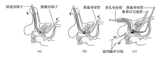 尿道会师术