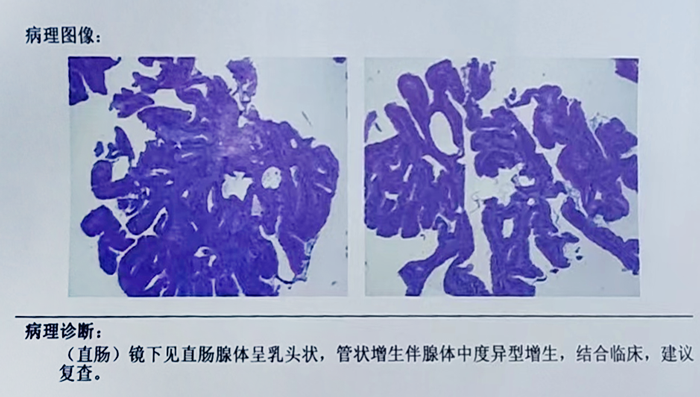 病理结果