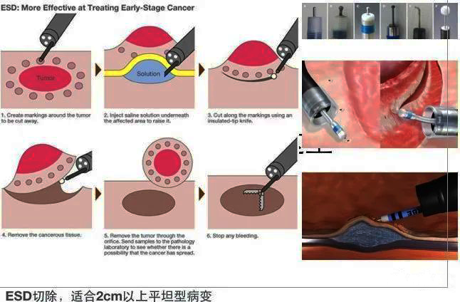 内镜粘膜下剥离术（ESD）