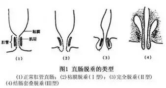 直肠粘膜内脱垂