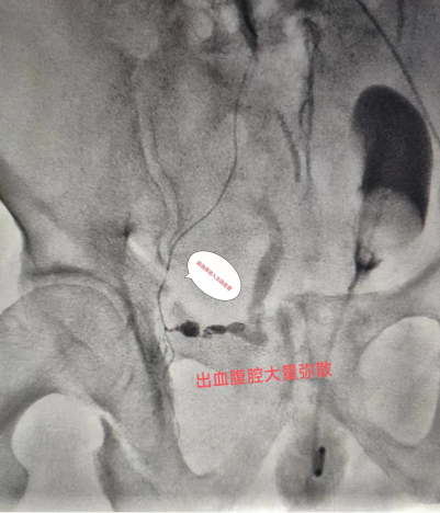 术中可见动脉破裂出血，超选入出血动脉造影证实