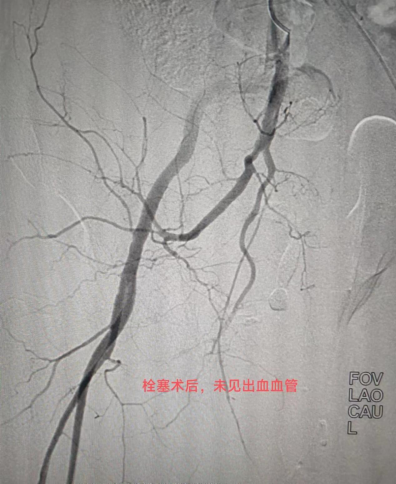 栓塞后造影复查，动脉出血消失