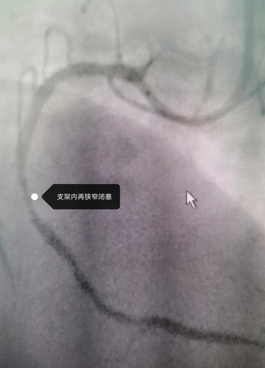 “先诊疗、后付费”——为急性心肌梗死抢救加速！