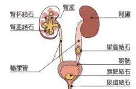 小小结石不可小觑，差点就酿成大祸!