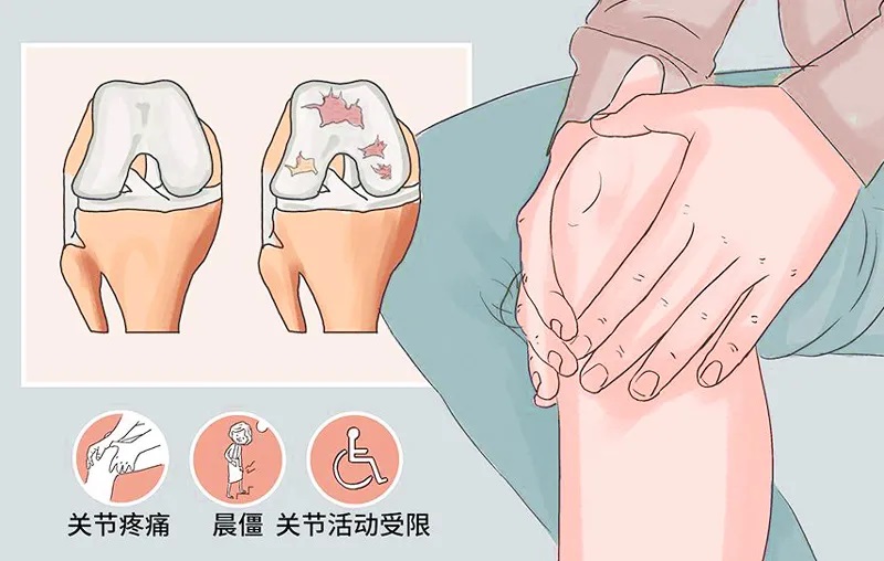 膝关节疼痛切勿强忍，且行且珍“膝”！