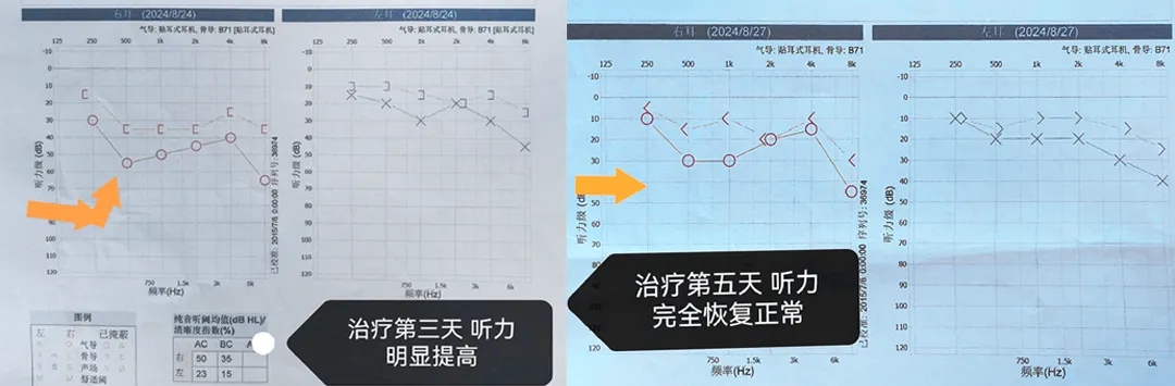 突然听不见？原来是这个听力杀手在作祟！