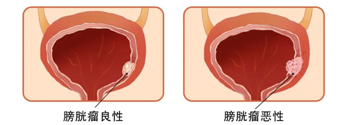 马桶里的“红色预警”，原因竟是....